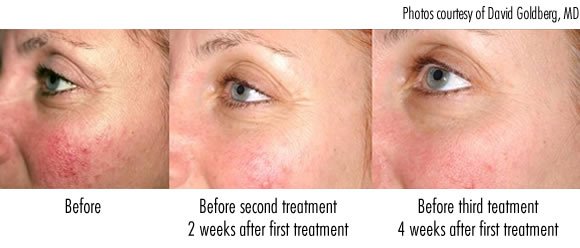 How To Cure Rosacea On Face Naturally How To Cure Rosacea On Face Naturally