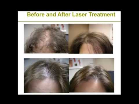 red light therapy for hair growth before and after