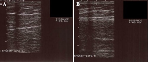 red light therapy cellulite before and after
