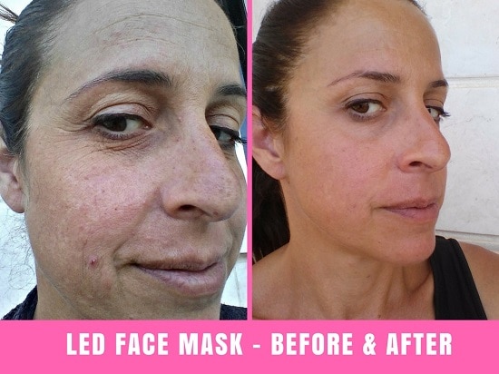 project e led therapy mask before and after