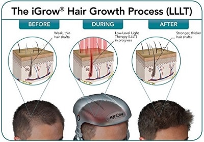 igrow hair growth helmet before and after