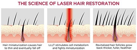 how laser regrows hair