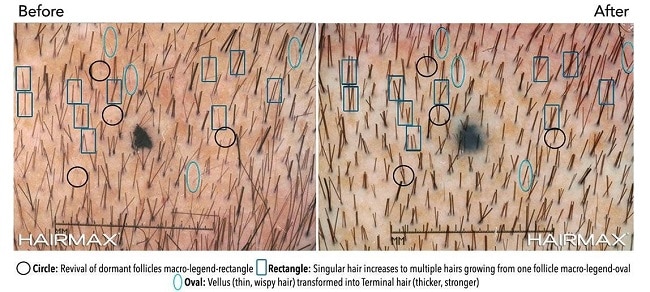 laser combs studies