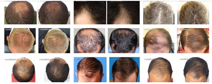 red light therapy hair loss