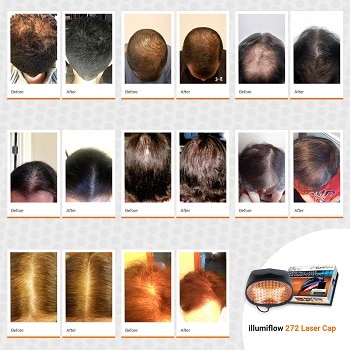 illumoflow laser hair cap before and after