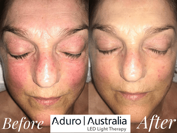 red light therapy for rosacea before and after