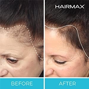 HairMax laser cap before and after