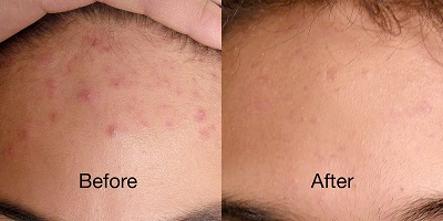 revive light therapy how to use