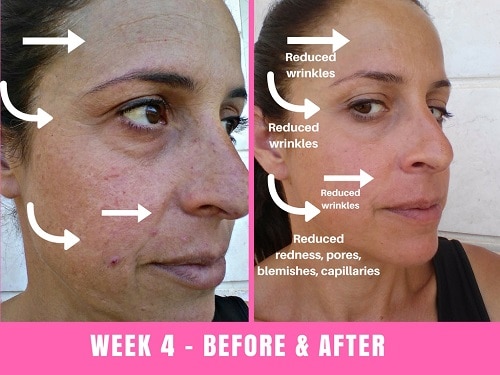 led face mask treatment results