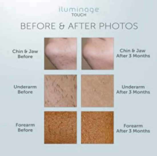 Illuminage touch before and after
