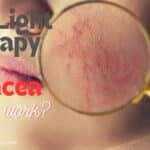 red light therapy for rosacea