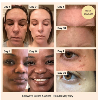 solawave wand before and after