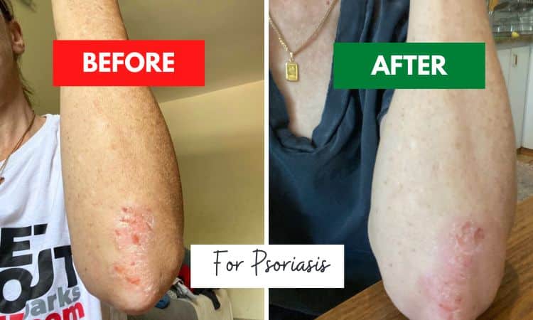 red light therapy for psoriasis before after