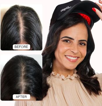capillus pro fda cleared laser cap