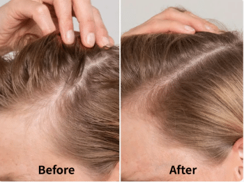 lumiheal pro hair growth laser comb and scalp massager